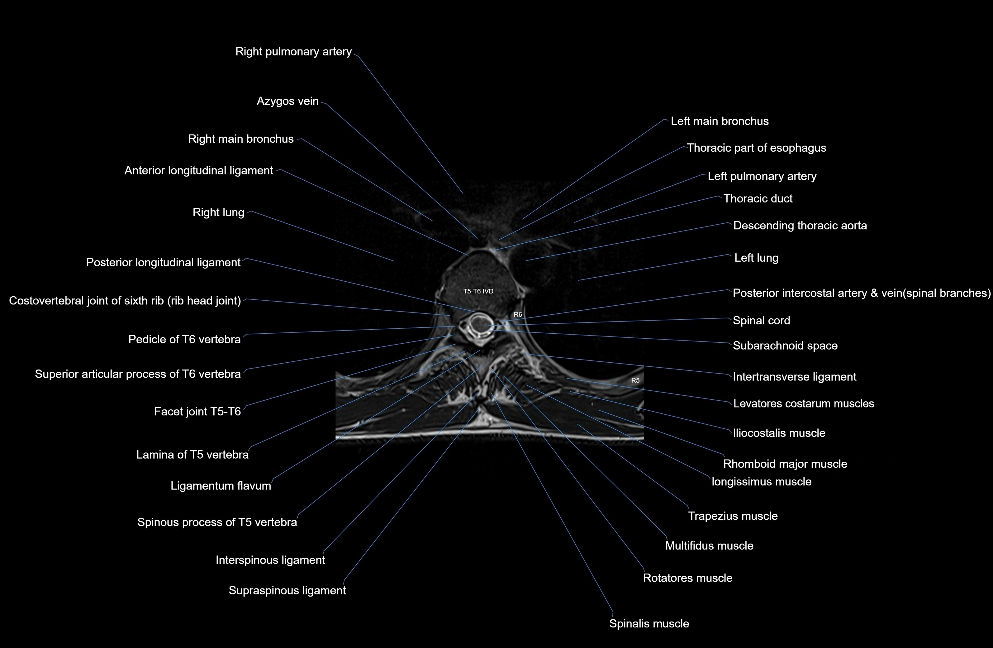 MRI thoracic spine axial  cross sectional anatomy 3T radiology  image-img-00001-00036.webp